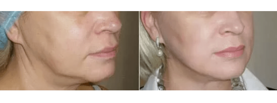 cilt gençleştirme sonrası iyileşme