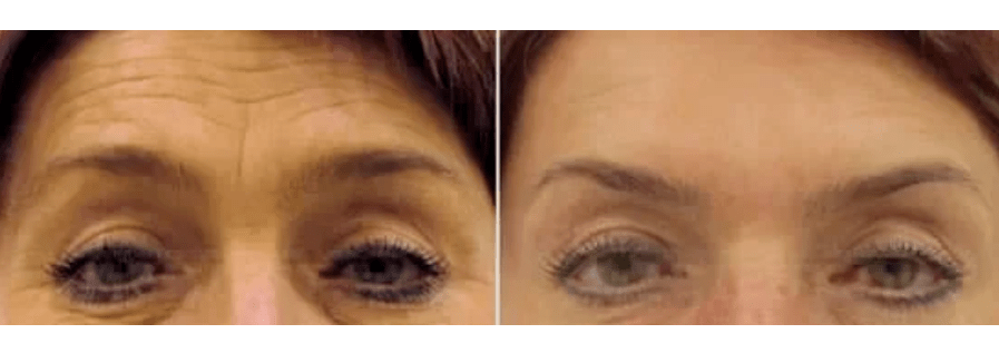 fraksiyonel gençleştirme için cihazlar